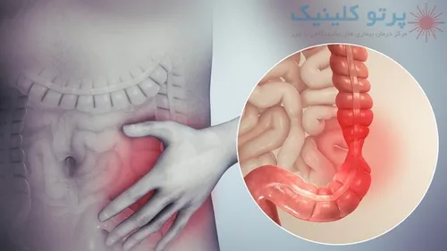 از کجا بفهمیم سندروم روده تحریک پذیر داریم