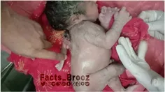 تولد نوزاد پسر با سه دست در هند همه را شگفت‌زده کرد!