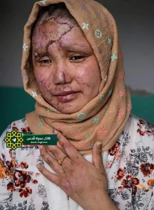🔸تصویر یکی از مجروحین حادثه تروریستی در کابل 
🔹شرمنده که هیچ کس برای شماها هیچ استوری نمی گذارد، خون شما برایشان ارزش سیاسی ندارد...