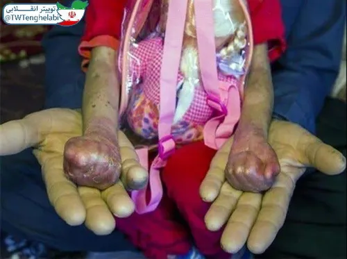 ⭕️ اینها دستهای یه کودک مبتلا به بیماری ای بی یا پروانه ا