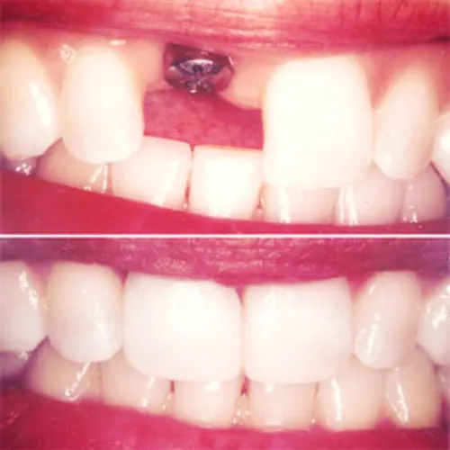 کاشت دندان و ایمپلنت دندان