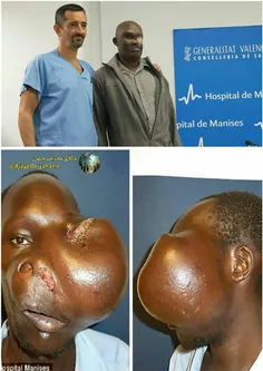 کنیا مایک که بارشد عجیب توموری در سمت راست صورتش بینایی‌ا