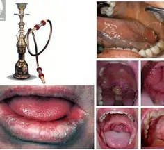 سرطان دهان،بر اثر کشیدن سیگار و قلیون،مخصوصا سر شلنگیهای 