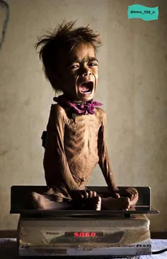 وضعیت اسف بار کودکان در یمن که از سوء تغذیه شدید رنج میبر