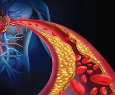 ️ چه کسانی در خطر بالای ابتلا به چربی خون بالا قرار دارند