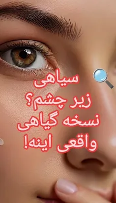 تیرگی زیر چشم از چی!!