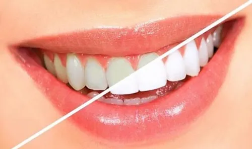 🚺 سفید کردن دندان