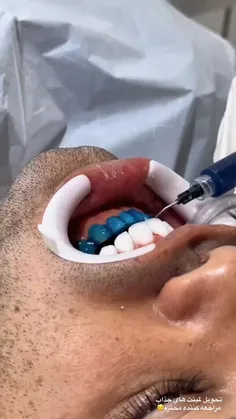 لمینت دندان اقساطی در مشهد انجام می شود!