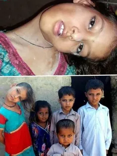 بیماری عجیب دختر پاکستانی و فراخوان کمک در فضای مجازی