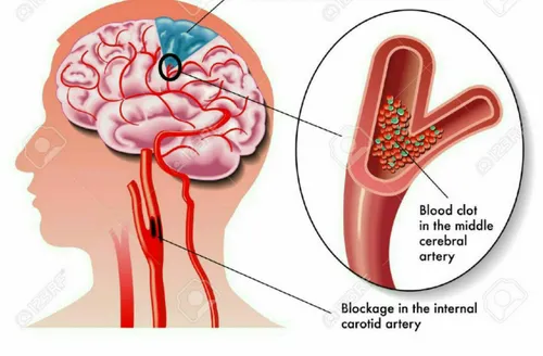 🔵 افرادی که سکته می کنند باید تا ۵ سال مراقب باشند