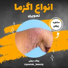 انواع اگزما 