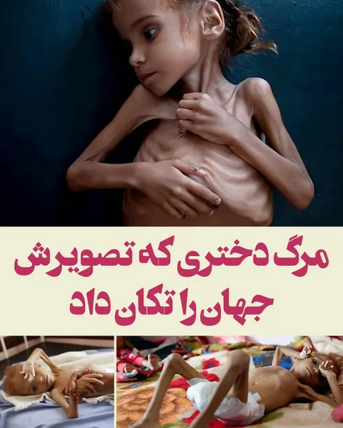 📸 « امل حسین» دختر بچه هفت ساله یمنی که از شدت ضعف و گرسن