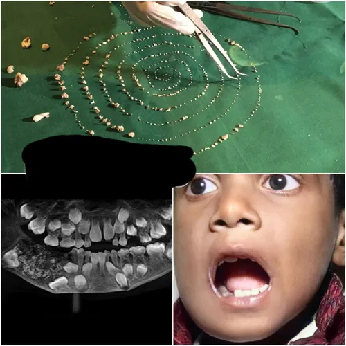 پر دندان ترین کودک دنیا !