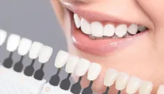کامپوزیت دندان چیست و چه مزایا و معایبی دارد؟ + قیمت