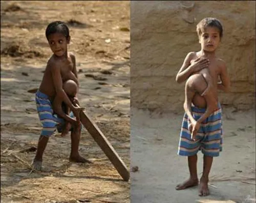 پسر هندی با بیماری عجیب از شر ” دوقلوی انگلی ” خود در قفس
