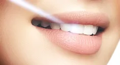 روش های بلیچینگ دندان | سفید کردن ها