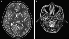 تصادفی به این عکس برخوردم؛ MRI مریضی که لارو کرم نواری وا