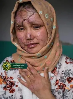 🔸تصویر یکی از مجروحین حادثه تروریستی در کابل 
🔹شرمنده که هیچ کس برای شماها هیچ استوری نمی‌گذارد، خون شما برایشان ارزش سیاسی ندارد...