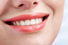 از ونیر دندان میتوان جهت پر کردن فضاهای خالی بین دندان ها