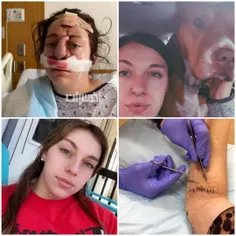 ترینیتی راولس دختر 20 ساله آمریکایی قبل و بعد از حمله سگ 