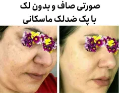 مزاجشناسی روشن هستم مشاورپوست ومو ودرمانگر  میخوای صورتت مثل ماه شب چهارده بدرخشه؟؟؟؟بیا کمکت کنم