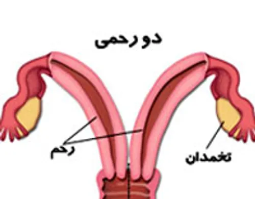 برخی زنان دو رحم دارند