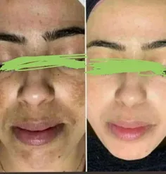 روی صورت لکه های تیره ایجاد میشه 😱😱😱