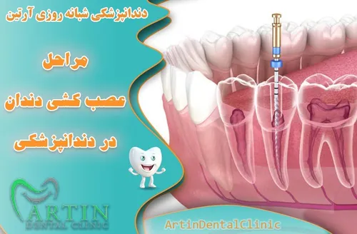 مراحل عصب کشی دندان در دندانپزشکی ( مراحل اصولی )