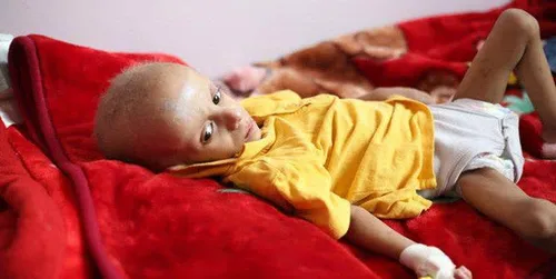 وزارت بهداشت یمن: هر ۱۰ دقیقه یک کودک یمنی به دلیل سوء تغ