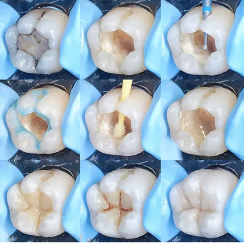 نمونه از کانال دندان