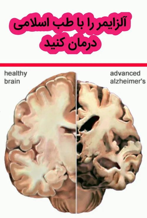 تقویت حافظه (ضدآلزایمر)