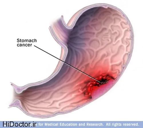 سرطان معده                          کاهش اشتها، کاهش وزن،