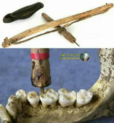 سابقه کار دندانپزشکی در تمدن دره سند به7000سال قبل از میل