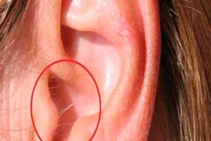 موهای زائد داخل گوش نشانه چیست