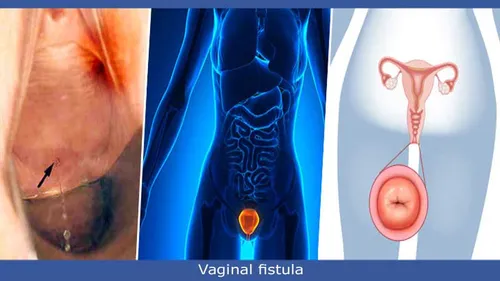 تشخیص بیماری فیستول در زنان یا فیستول واژن و راه های درمان