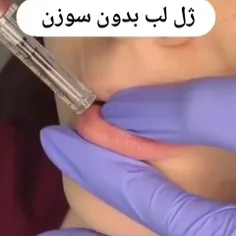 ژل لب بدون سوزن با دستگاه هیالورون پن 😍