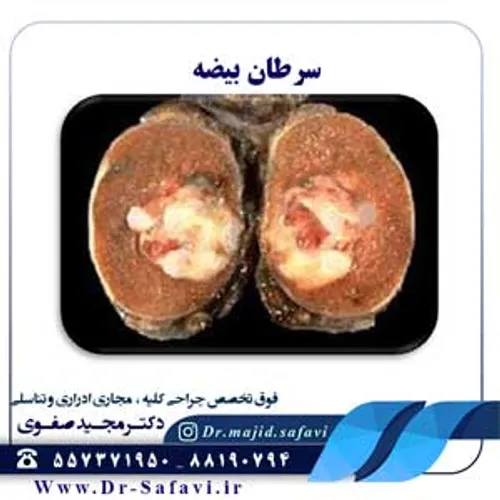 سرطان بیضه، سرطان بدخیم و خطرناک و در عین حال در صورت تشخ