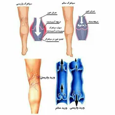 #واریس چیست؟وقتی که جریان گردش خون به درستی انجام نشود، ر