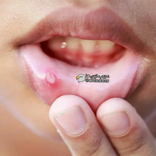 زخم دهان در اثر یبوست، نوسانات هورمونی و کمبود ویتامین ای