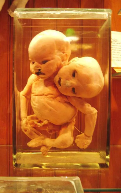 این جنین که در میان ظرف فرمالدهید قرار گرفته از بدنی واحد