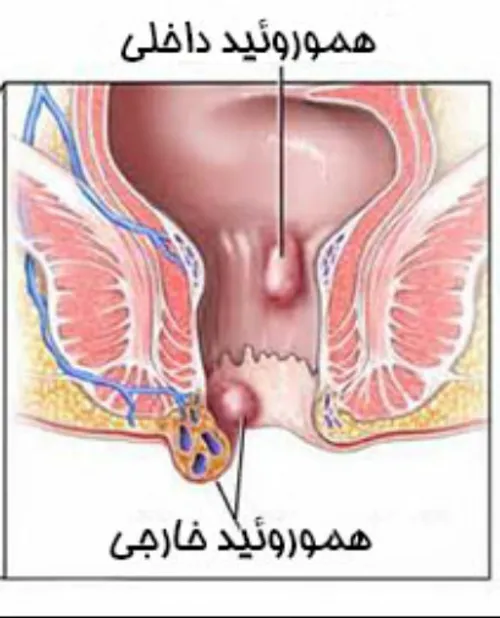 همورویید یا بواسیر و راه درمان آن از دیدگاه طب سنتی.