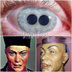 چشم دو مردمکی ( Pupula duplex) یک ناهنجاری نادر چشمی است 