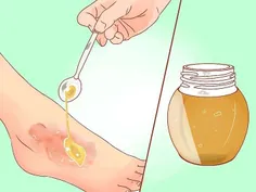 مالیدن مرتب عسل در سوختگیهای سطحی مانع تاول زدن وباعث ترم