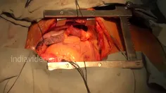 جراحی قلب