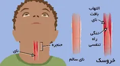 🔸 اگر کودکتان مبتلا به خروسک شد، تا سه شبانه روز هوای اتا