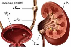 #شکر عامل ایجاد #سنگ_کلیه و #سنگ_مثانه است