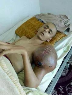 پسری ۲۱ ساله توده سرطانی توی دستش داره اسمش محمد رضاست گو