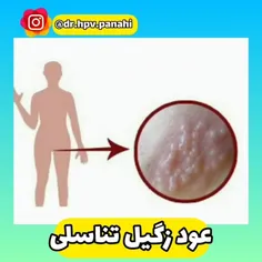 🔹نکات مهم برای جلوگیری از عود زگیل تناسلی