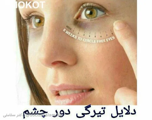 ✅دلایل تیرگی دور چشم