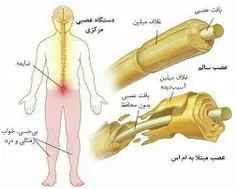 بیماری MS  از کجا می آید؟ 